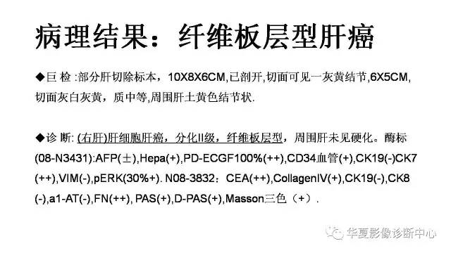 【病例】纤维板层型肝癌1例CT影像表现