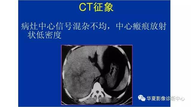 【病例】纤维板层型肝癌1例CT影像表现