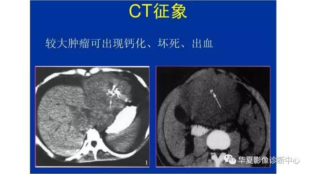 【病例】纤维板层型肝癌1例CT影像表现