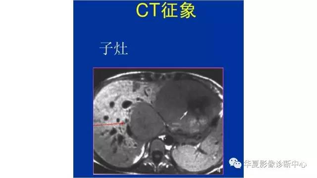 【病例】纤维板层型肝癌1例CT影像表现