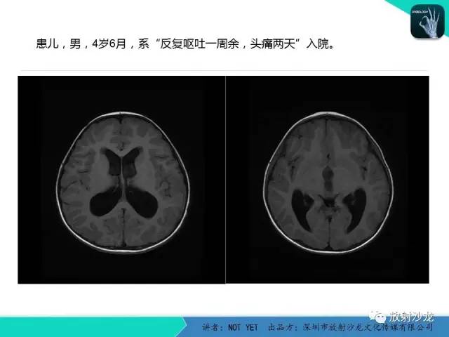 【病例】四脑室室管膜瘤1例MR 【病例】四脑室室管膜瘤1例MR