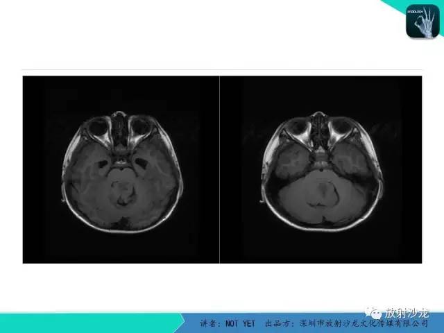 【病例】四脑室室管膜瘤1例MR 【病例】四脑室室管膜瘤1例MR