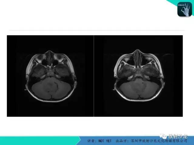 【病例】四脑室室管膜瘤1例MR 【病例】四脑室室管膜瘤1例MR