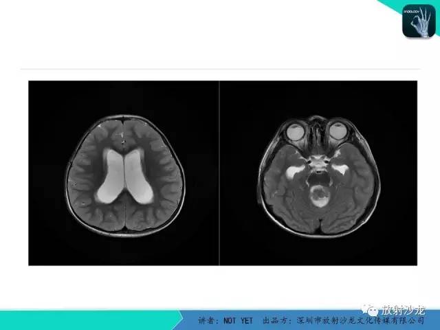 【病例】四脑室室管膜瘤1例MR 【病例】四脑室室管膜瘤1例MR