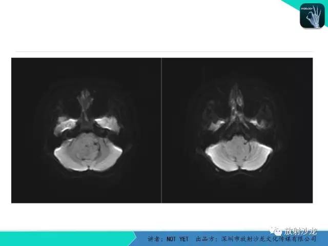 【病例】四脑室室管膜瘤1例MR 【病例】四脑室室管膜瘤1例MR