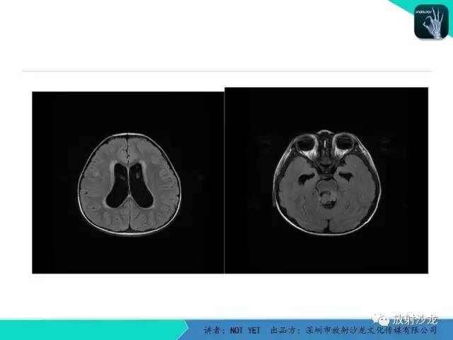 【病例】四脑室室管膜瘤1例MR 【病例】四脑室室管膜瘤1例MR