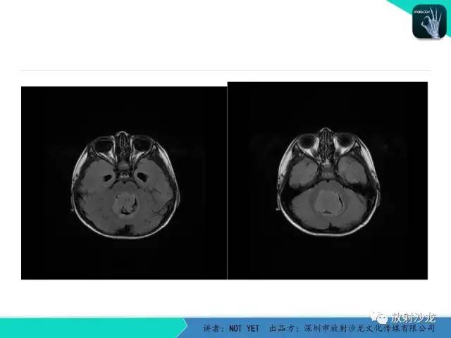 【病例】四脑室室管膜瘤1例MR 【病例】四脑室室管膜瘤1例MR