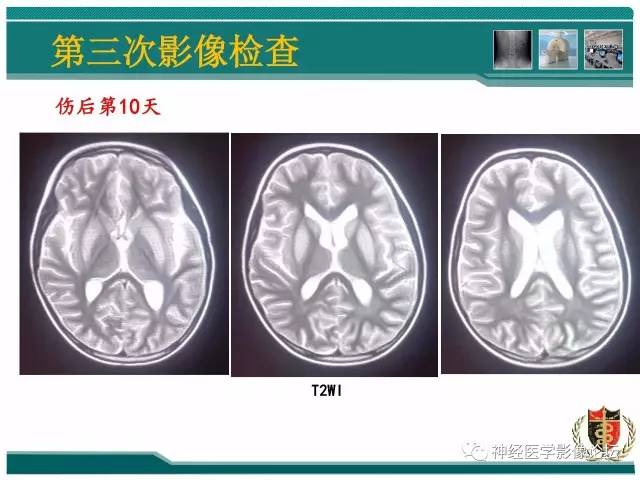 【病例】外伤后渗透性髓鞘溶解症一例MR 【病例】外伤后渗透性髓鞘溶解症一例MR