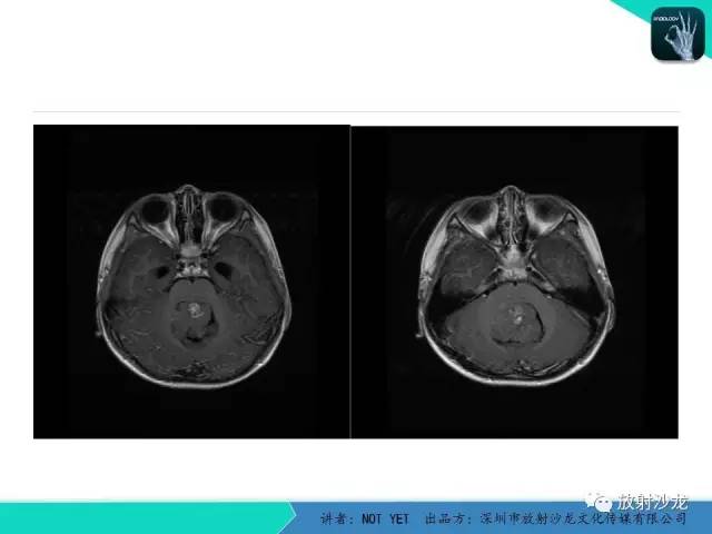 【病例】四脑室室管膜瘤1例MR 【病例】四脑室室管膜瘤1例MR