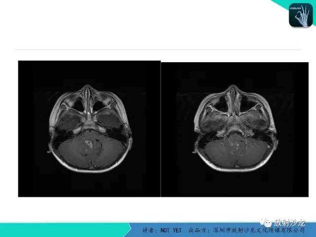 【病例】四脑室室管膜瘤1例MR 【病例】四脑室室管膜瘤1例MR