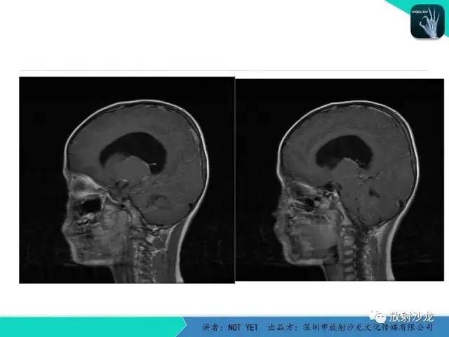 【病例】四脑室室管膜瘤1例MR 【病例】四脑室室管膜瘤1例MR