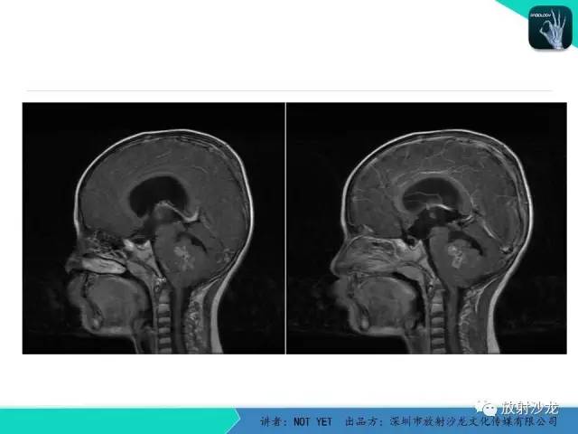 【病例】四脑室室管膜瘤1例MR 【病例】四脑室室管膜瘤1例MR