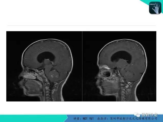 【病例】四脑室室管膜瘤1例MR 【病例】四脑室室管膜瘤1例MR