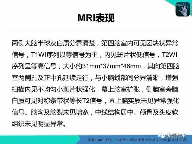 【病例】四脑室室管膜瘤1例MR 【病例】四脑室室管膜瘤1例MR