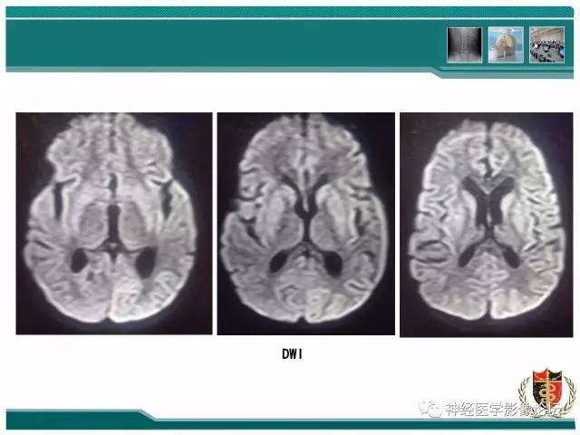 【病例】外伤后渗透性髓鞘溶解症一例MR 【病例】外伤后渗透性髓鞘溶解症一例MR