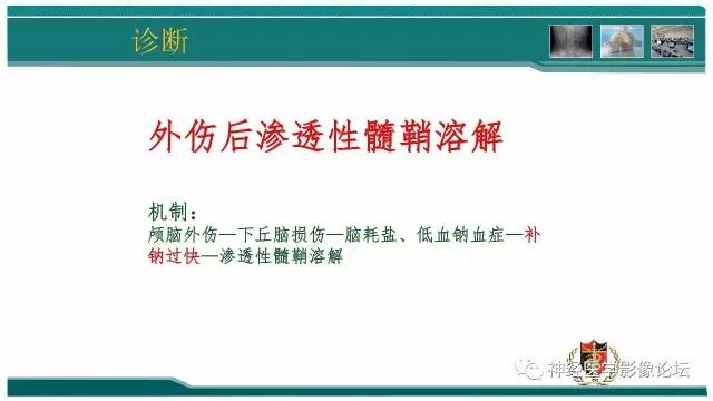 【病例】外伤后渗透性髓鞘溶解症一例MR 【病例】外伤后渗透性髓鞘溶解症一例MR