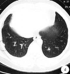 【病例】纵隔淋巴瘤1例CT影像表现 【病例】纵隔淋巴瘤1例CT影像表现