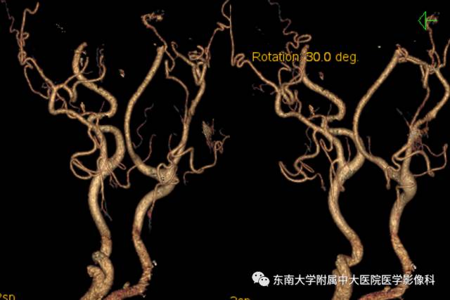 【病例】颈动脉体瘤1例CT影像表现