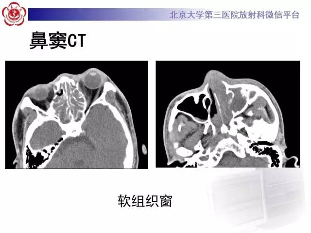 【病例】肉芽肿性多血管炎(韦格纳肉芽肿)1例CT