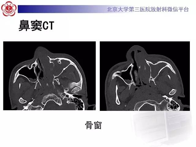 【病例】肉芽肿性多血管炎(韦格纳肉芽肿)1例CT