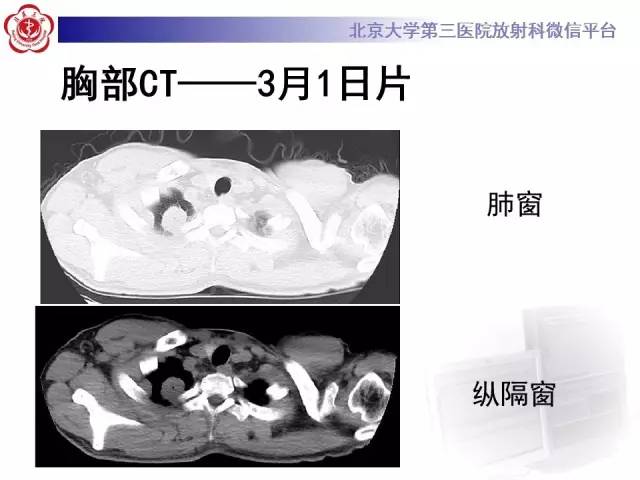 【病例】肉芽肿性多血管炎(韦格纳肉芽肿)1例CT