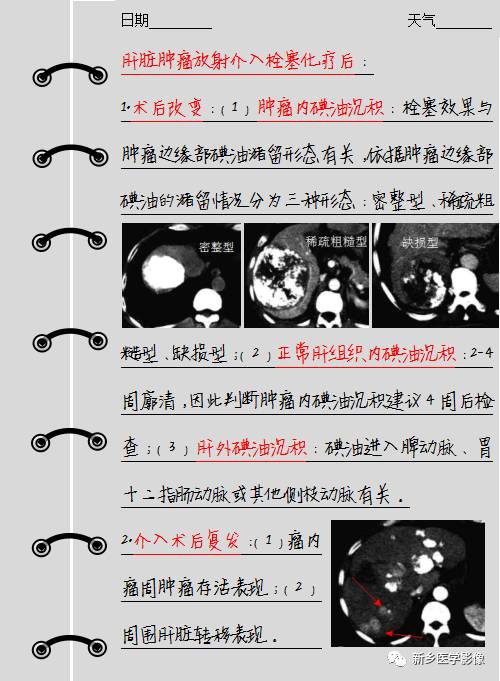 肝脏肿瘤放射介入栓塞化疗后的影像表现