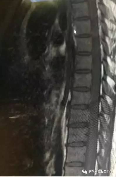 【病例】CT上完全钙化的脊膜瘤1例MR影像表现 【病例】CT上完全钙化的脊膜瘤1例MR影像表现
