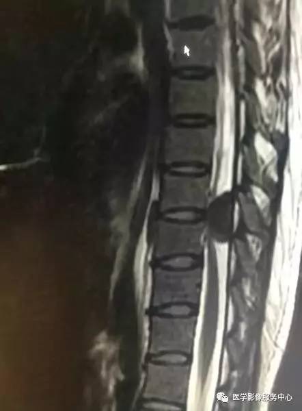【病例】CT上完全钙化的脊膜瘤1例MR影像表现 【病例】CT上完全钙化的脊膜瘤1例MR影像表现