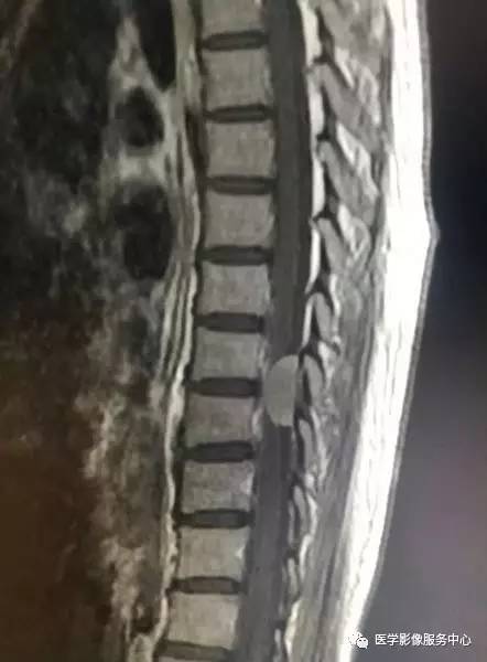 【病例】CT上完全钙化的脊膜瘤1例MR影像表现 【病例】CT上完全钙化的脊膜瘤1例MR影像表现