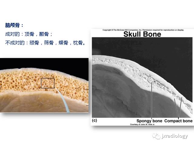 【PPT】颅骨增厚的影像学评价