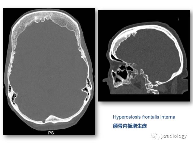 【PPT】颅骨增厚的影像学评价