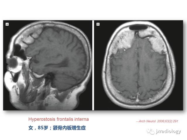 【PPT】颅骨增厚的影像学评价