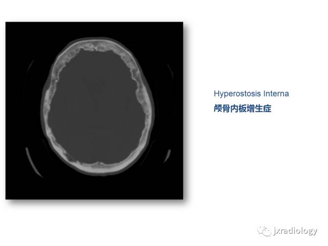 【PPT】颅骨增厚的影像学评价