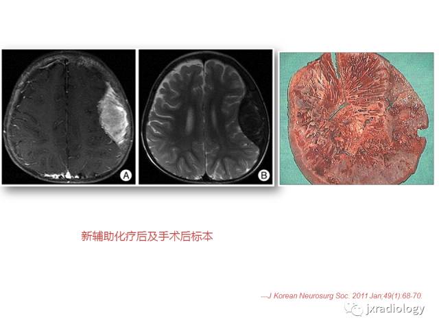 【PPT】颅骨增厚的影像学评价