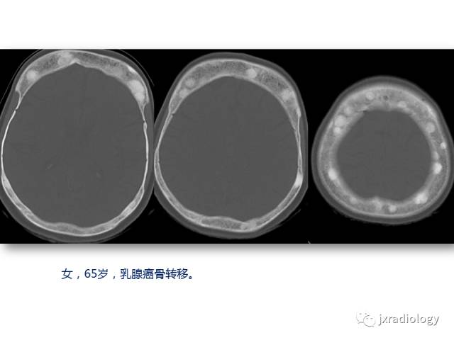 【PPT】颅骨增厚的影像学评价