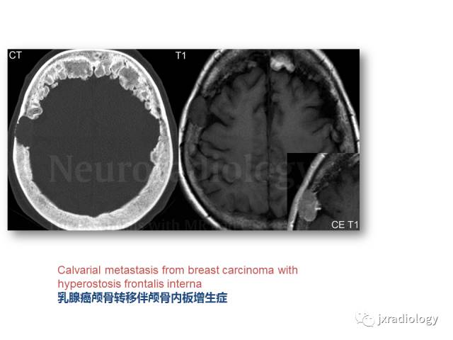 【PPT】颅骨增厚的影像学评价
