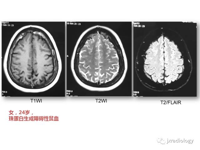 【PPT】颅骨增厚的影像学评价