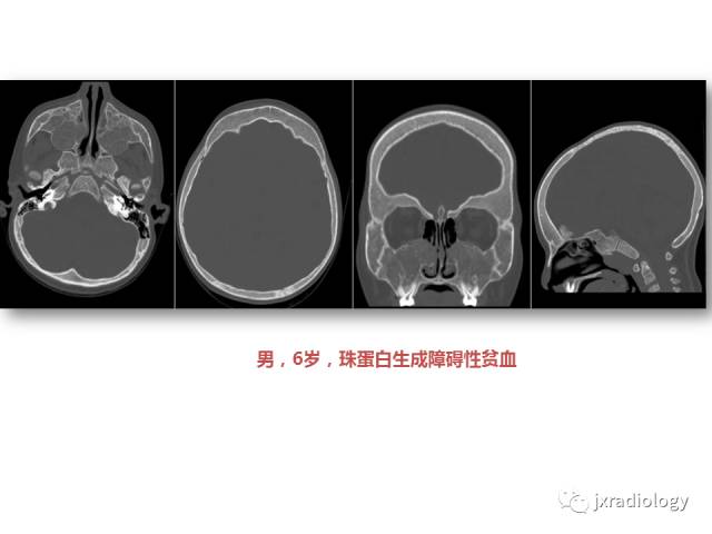 【PPT】颅骨增厚的影像学评价