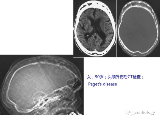 【PPT】颅骨增厚的影像学评价