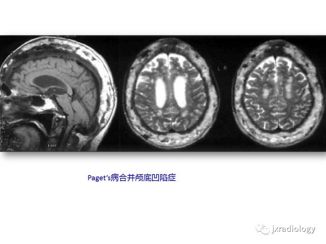 【PPT】颅骨增厚的影像学评价