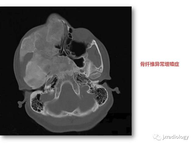 【PPT】颅骨增厚的影像学评价