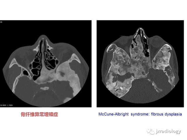 【PPT】颅骨增厚的影像学评价