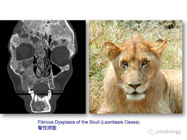 【PPT】颅骨增厚的影像学评价