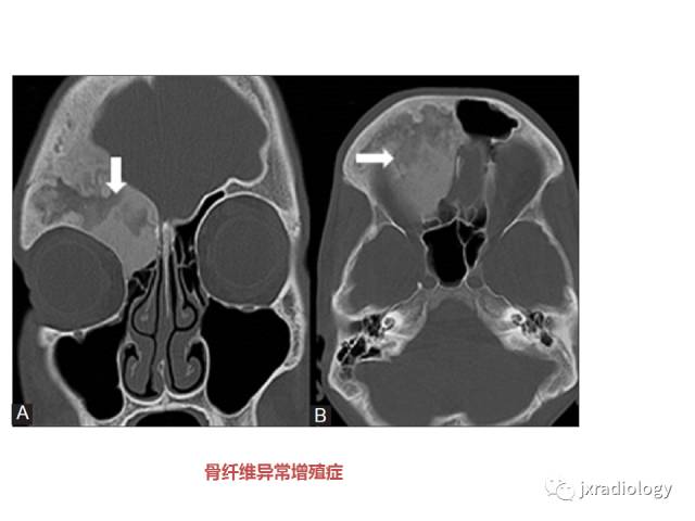 【PPT】颅骨增厚的影像学评价