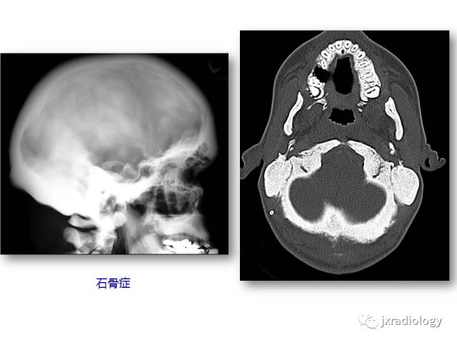 【PPT】颅骨增厚的影像学评价