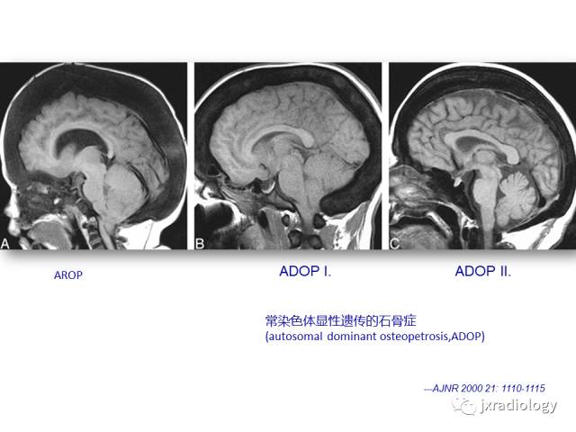 【PPT】颅骨增厚的影像学评价