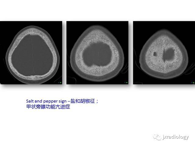 【PPT】颅骨增厚的影像学评价