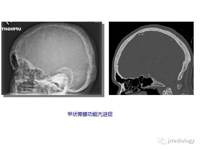 【PPT】颅骨增厚的影像学评价