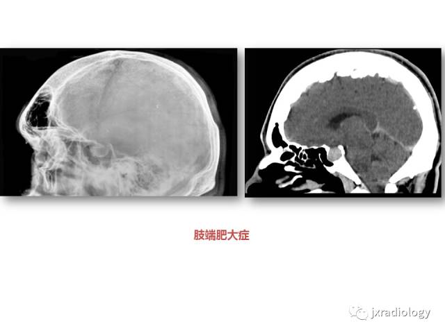 【PPT】颅骨增厚的影像学评价