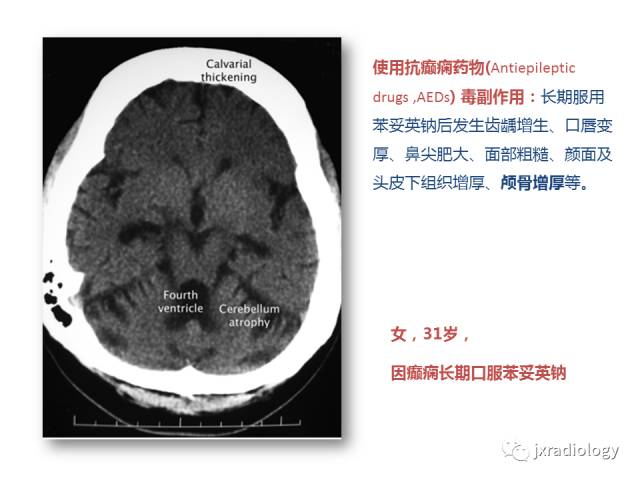【PPT】颅骨增厚的影像学评价